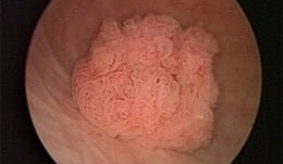 Urosepsa
